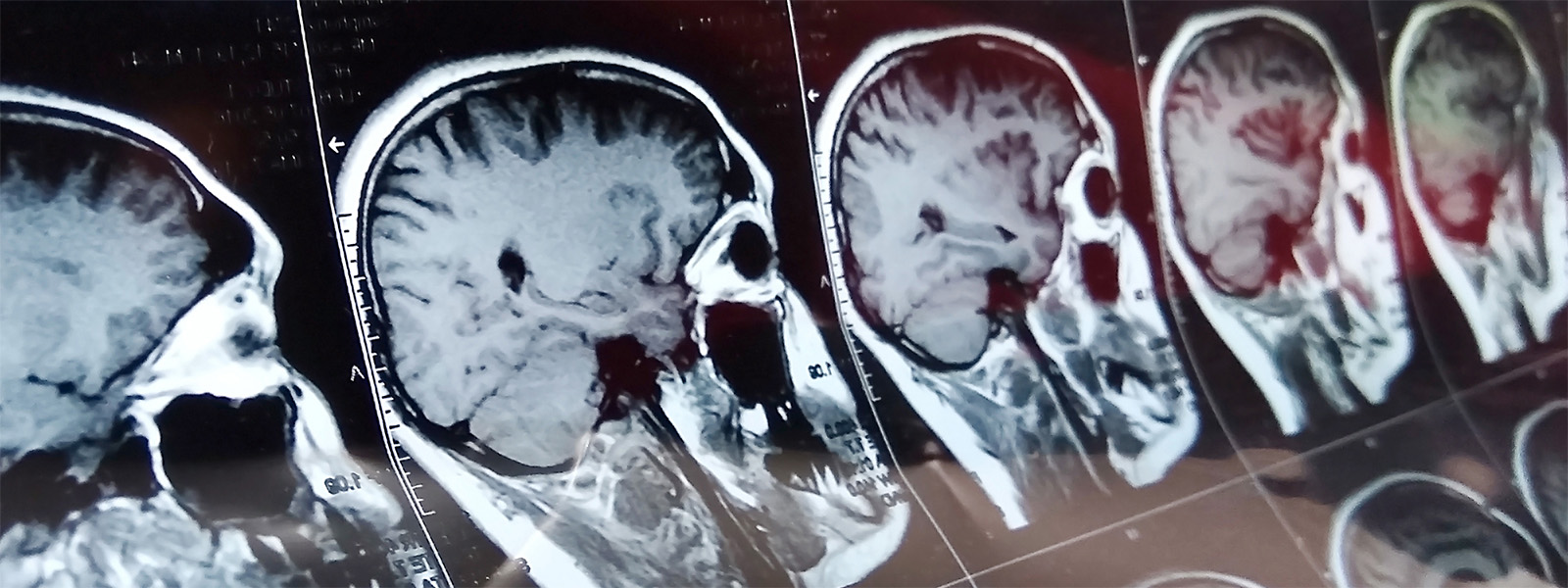 Brain CT Scans